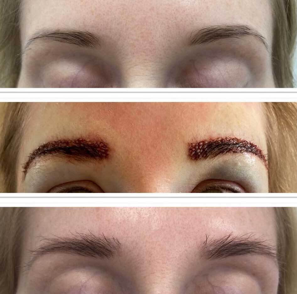 Пересадка бровей до и после