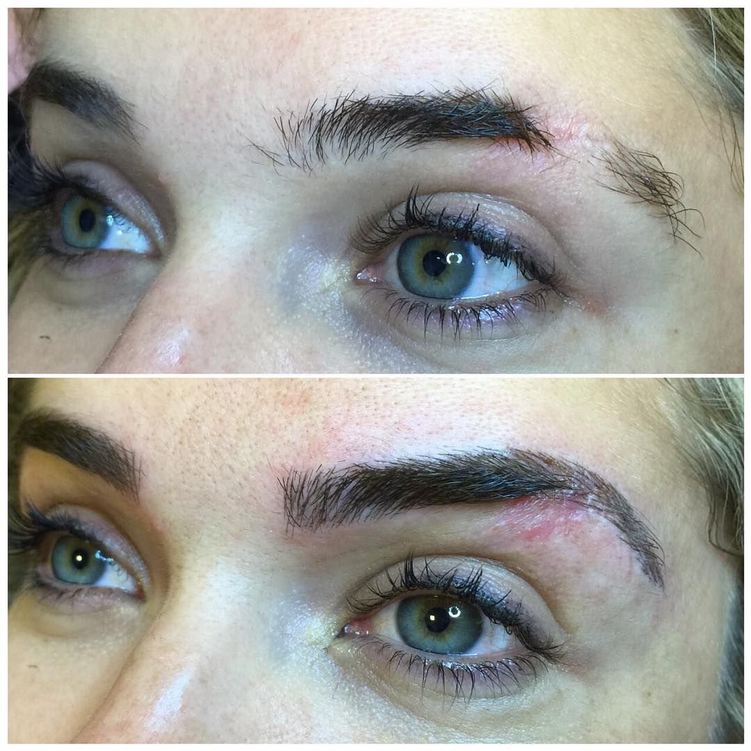 Пересадка бровей густота