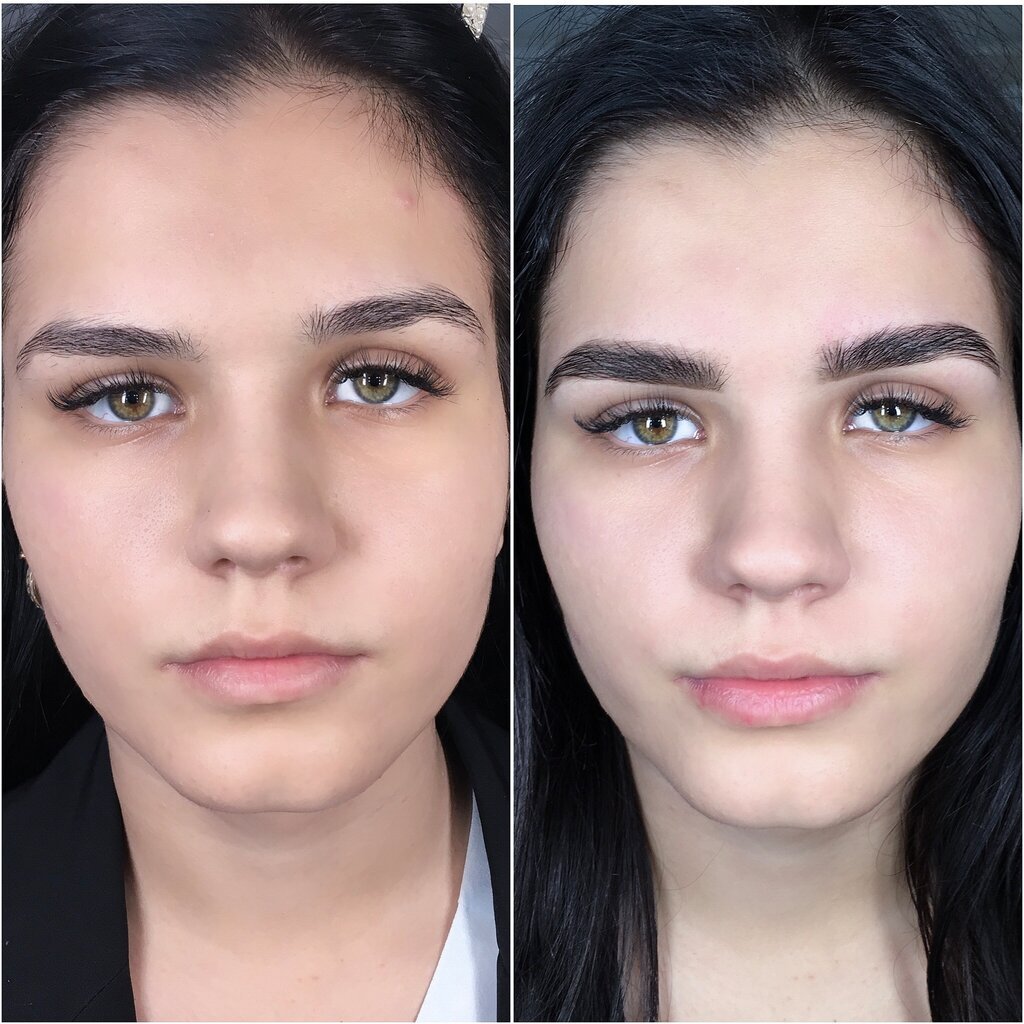 Мимическая асимметрия бровей