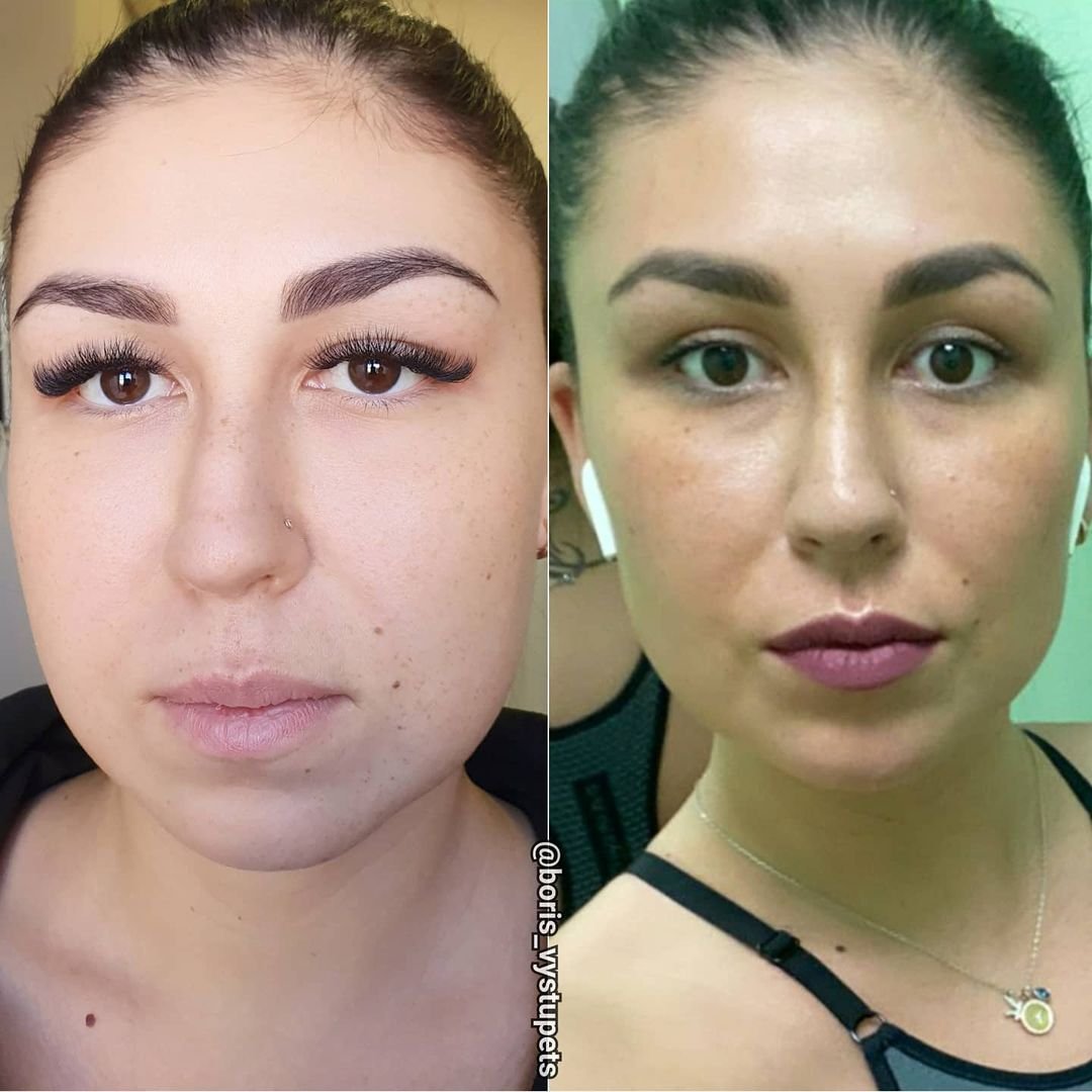 Асимметрия бровей до и после