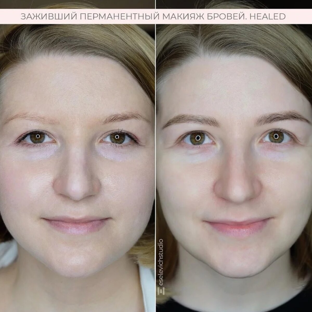 Исправление асимметрии лица