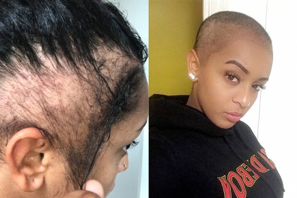 Прически для женщин с алопецией