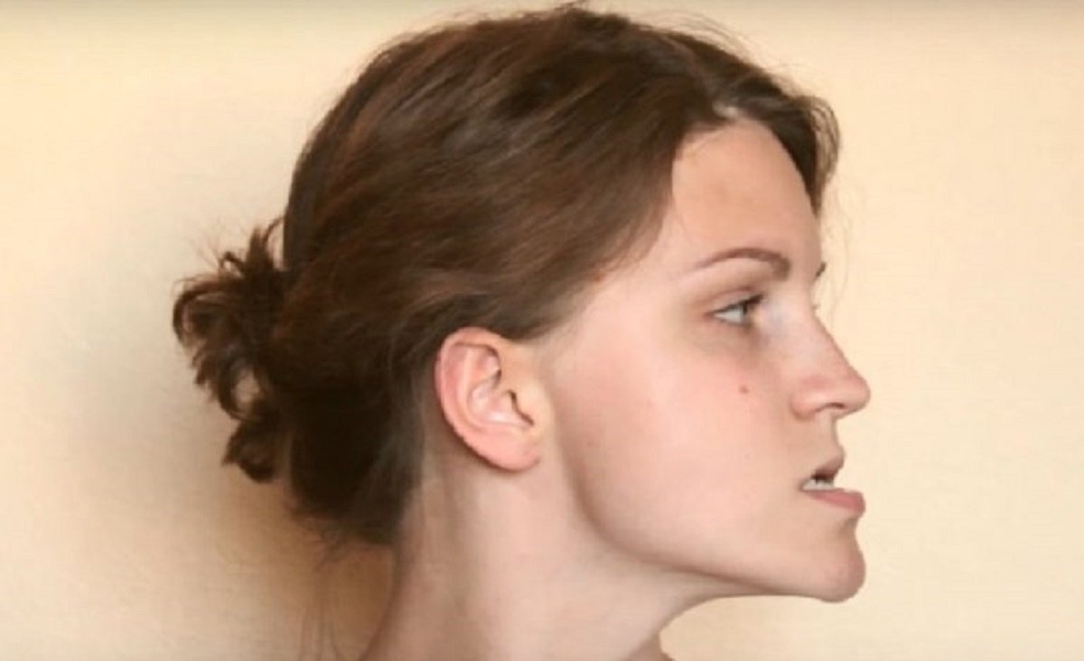 Мезиальный прикус профиль