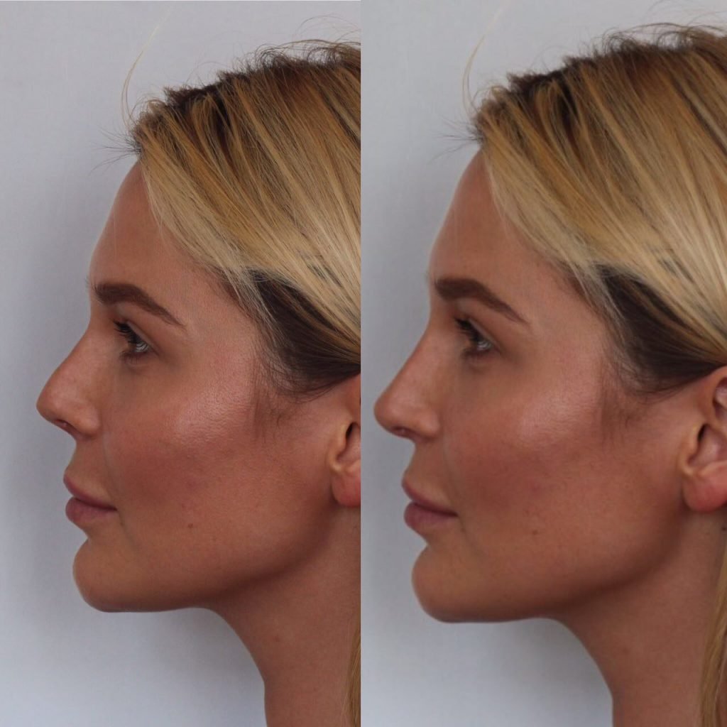 Аугментационная ринопластика