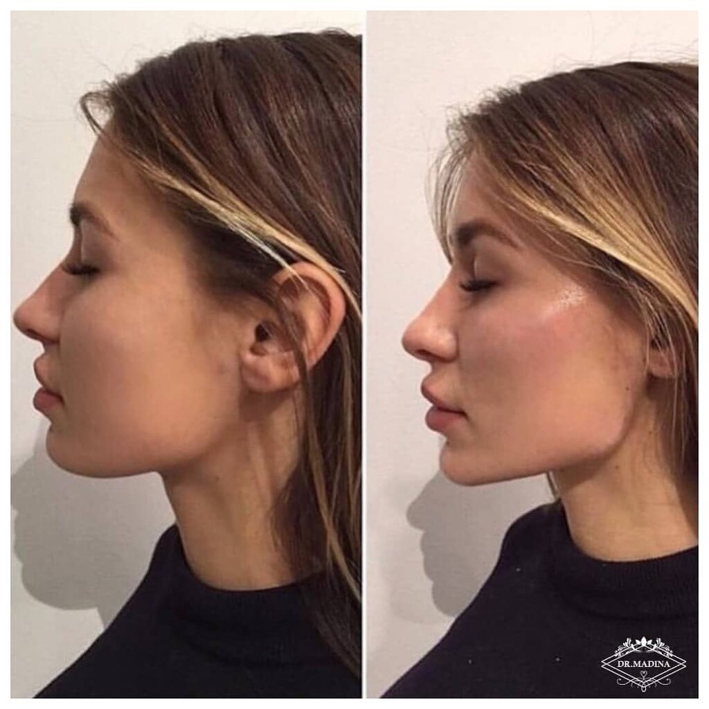 Профиль Джоли - углы нижней челюсти