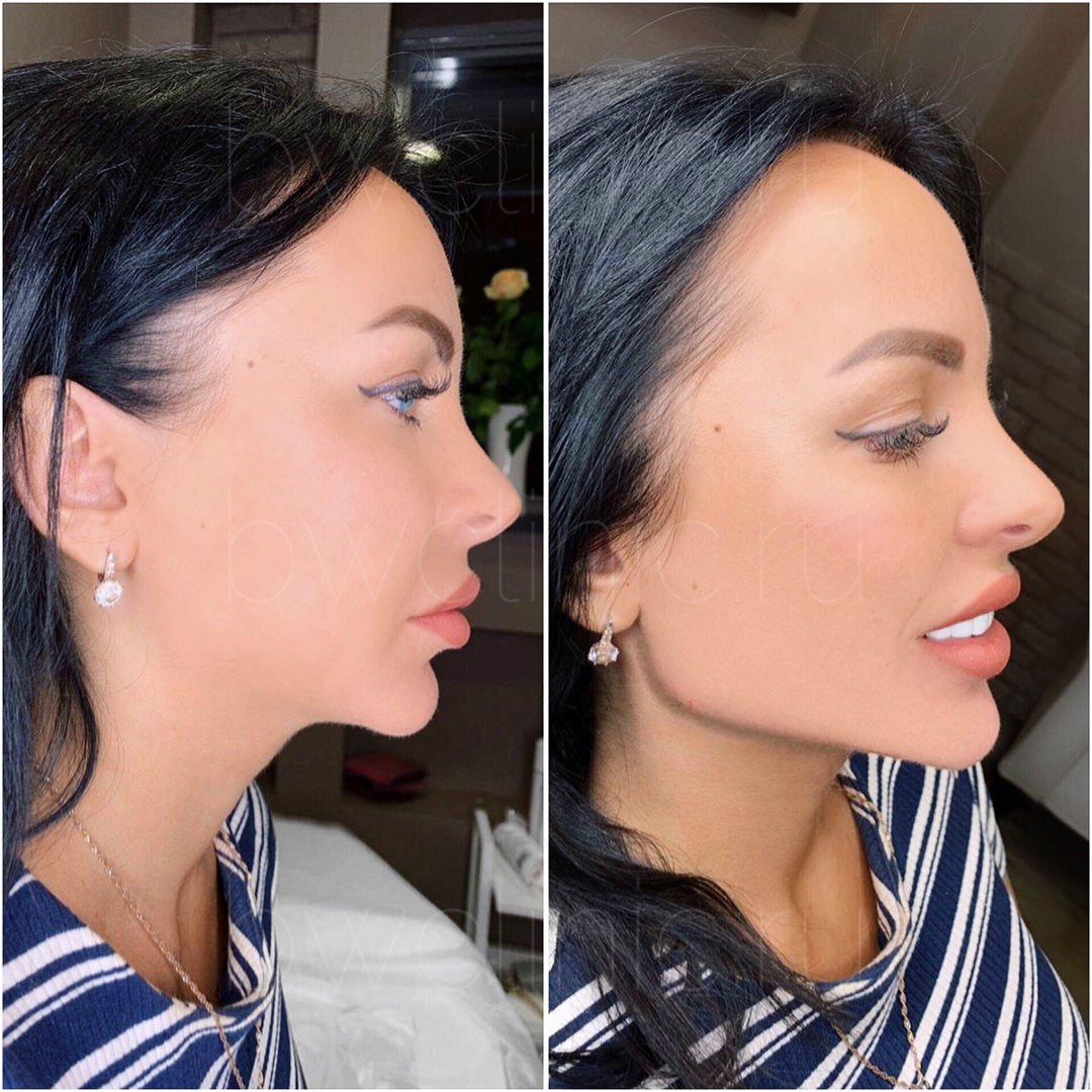 Профиль Джоли в косметологии