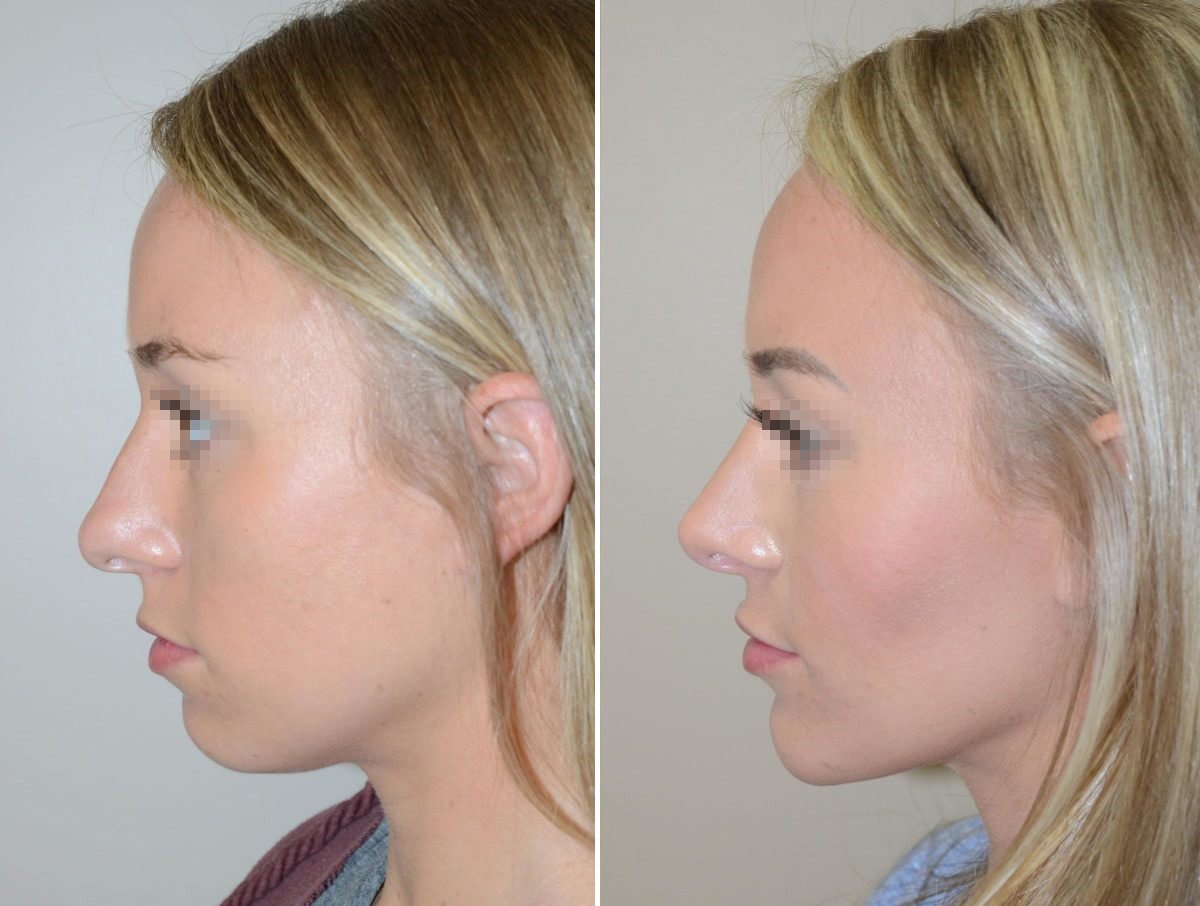 Остеотомическая ментопластика