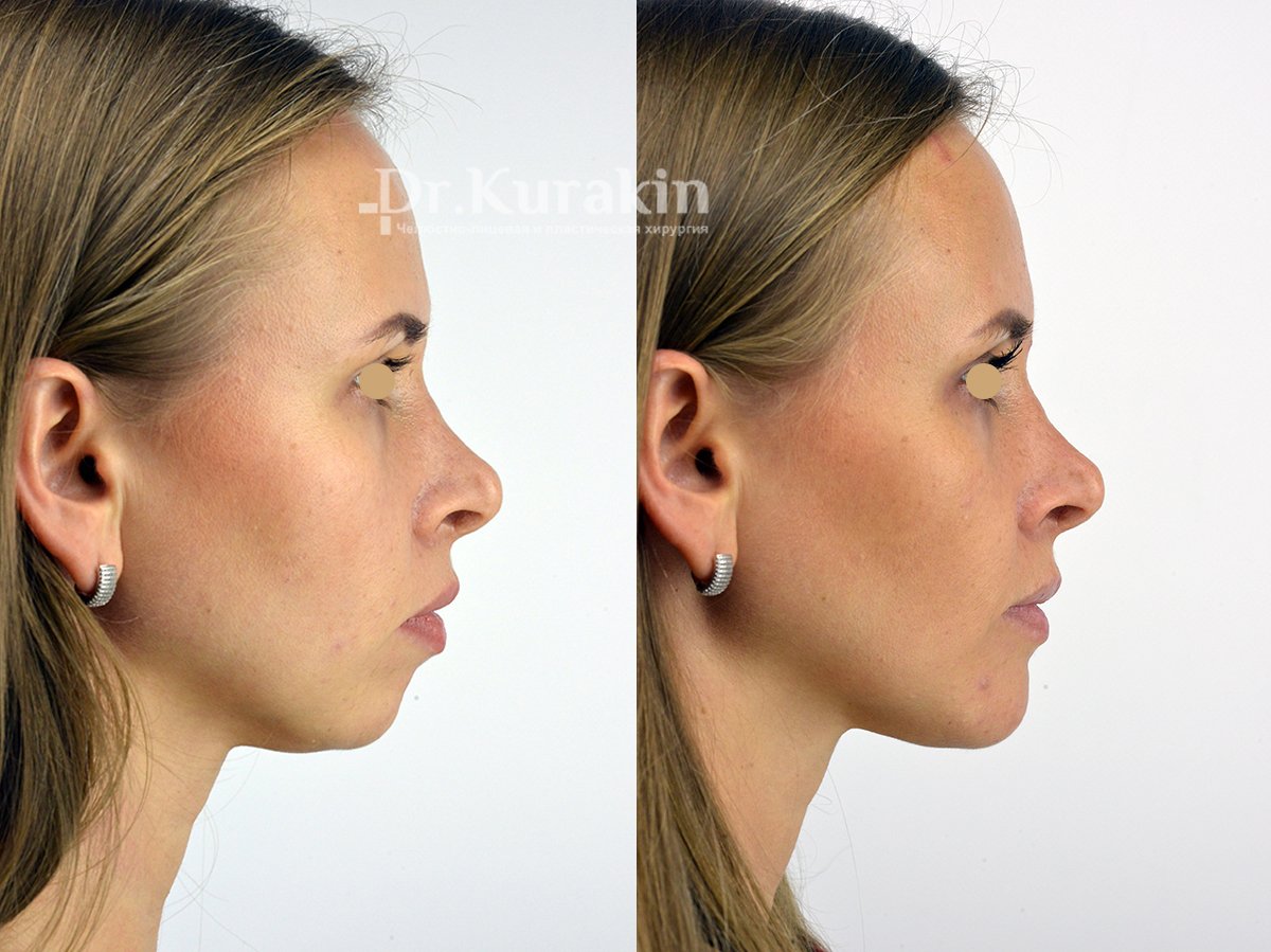 Ортогнатическая хирургия до и после