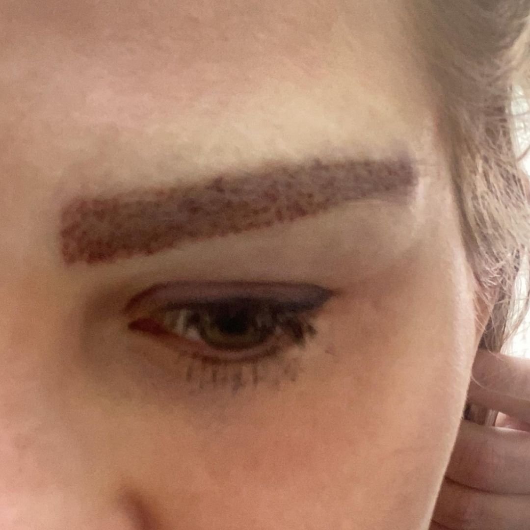 Пересаженные волосы на брови