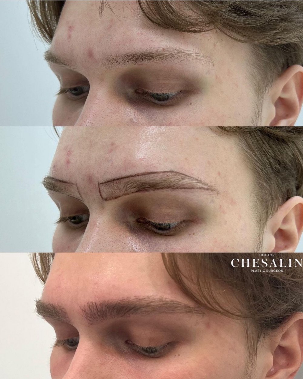 Пересадка бровей густота