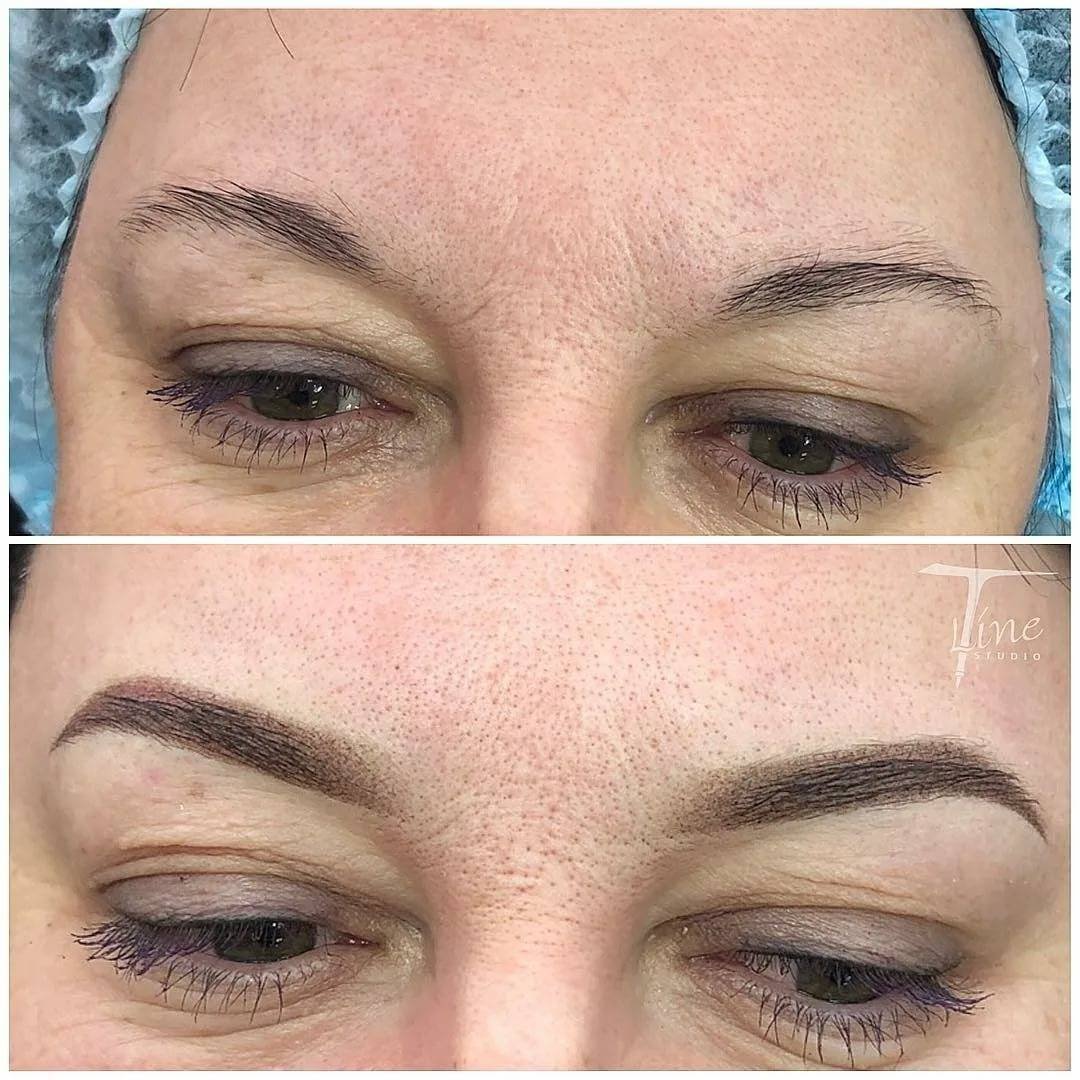 Трансплантация волос на брови