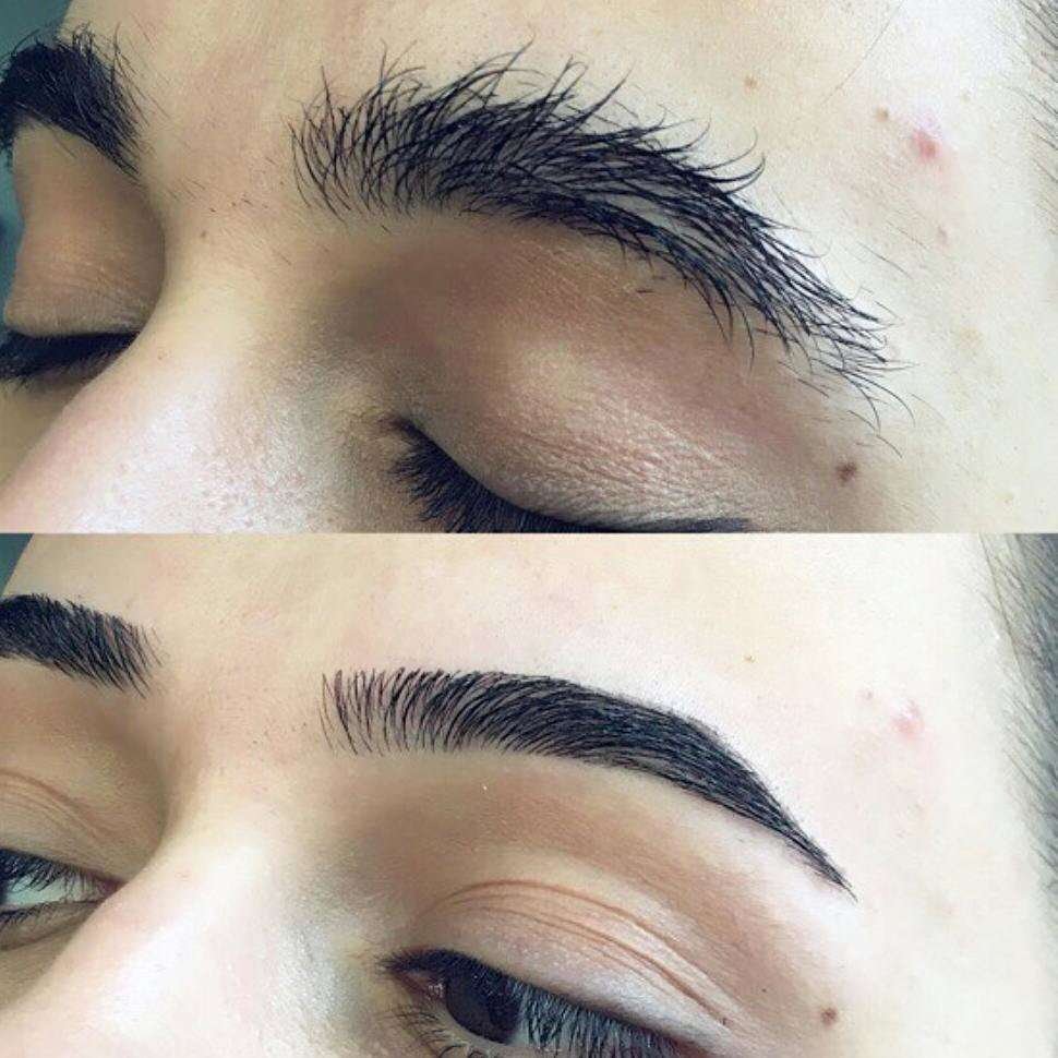 Операция по пересадке бровей