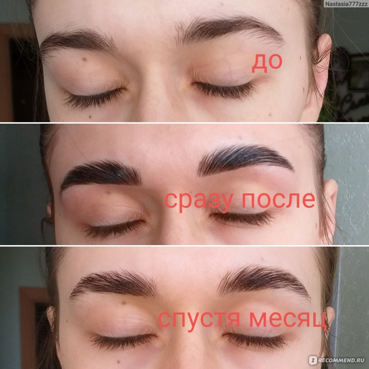 Трансплантация волос на брови