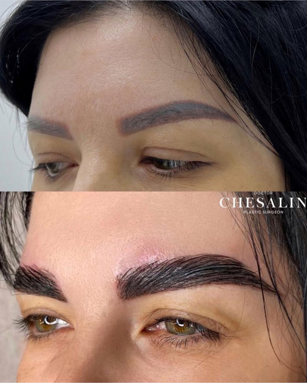 Трансплантация бровей до и после