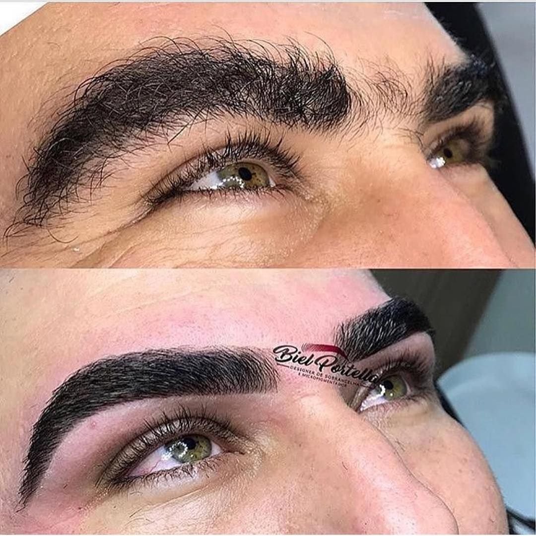 Трансплантация волос до и после