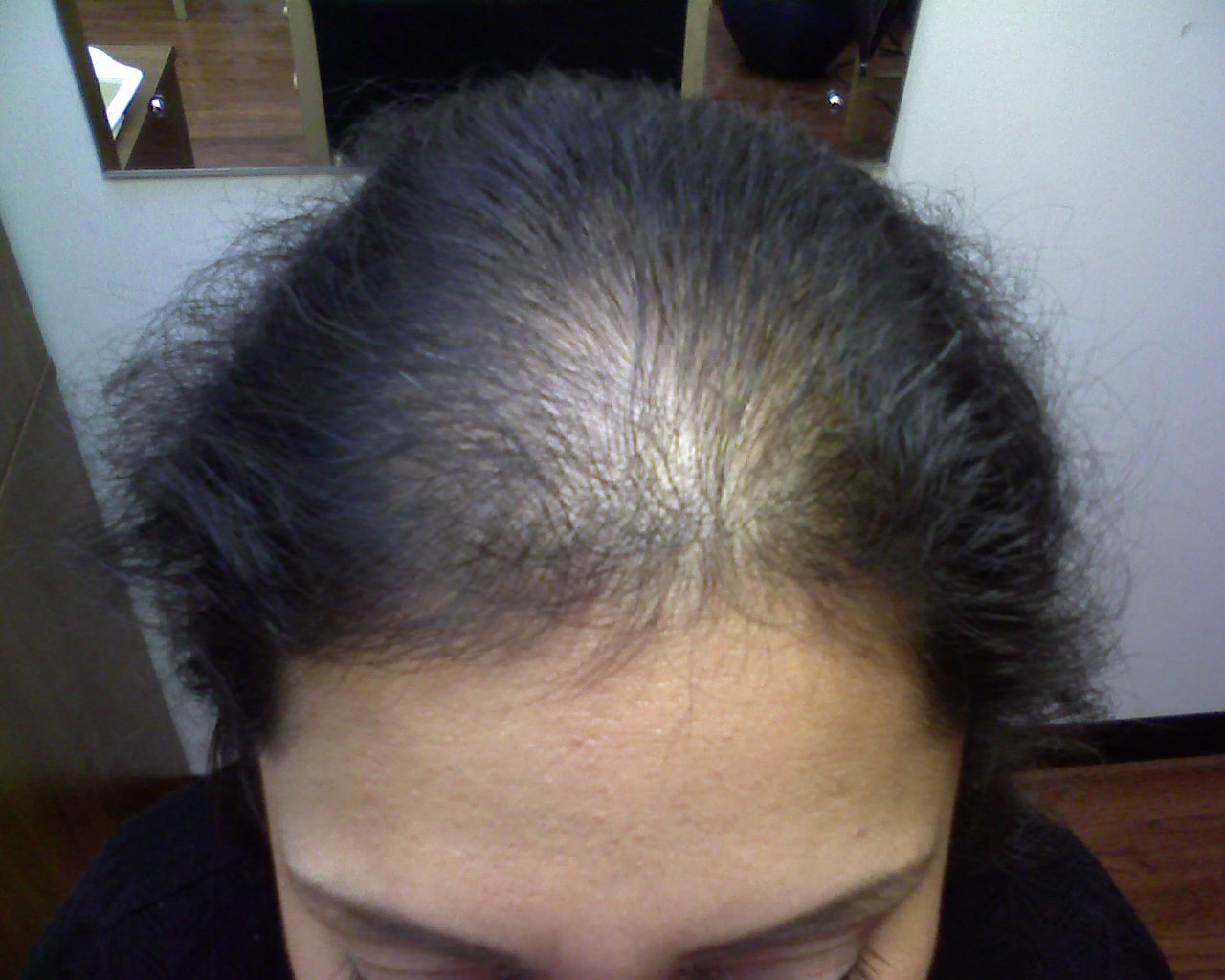 Ковид волосы выпадают что делать. Андрогенная алопеция алопеция. Диффузная телогеновая алопеция.