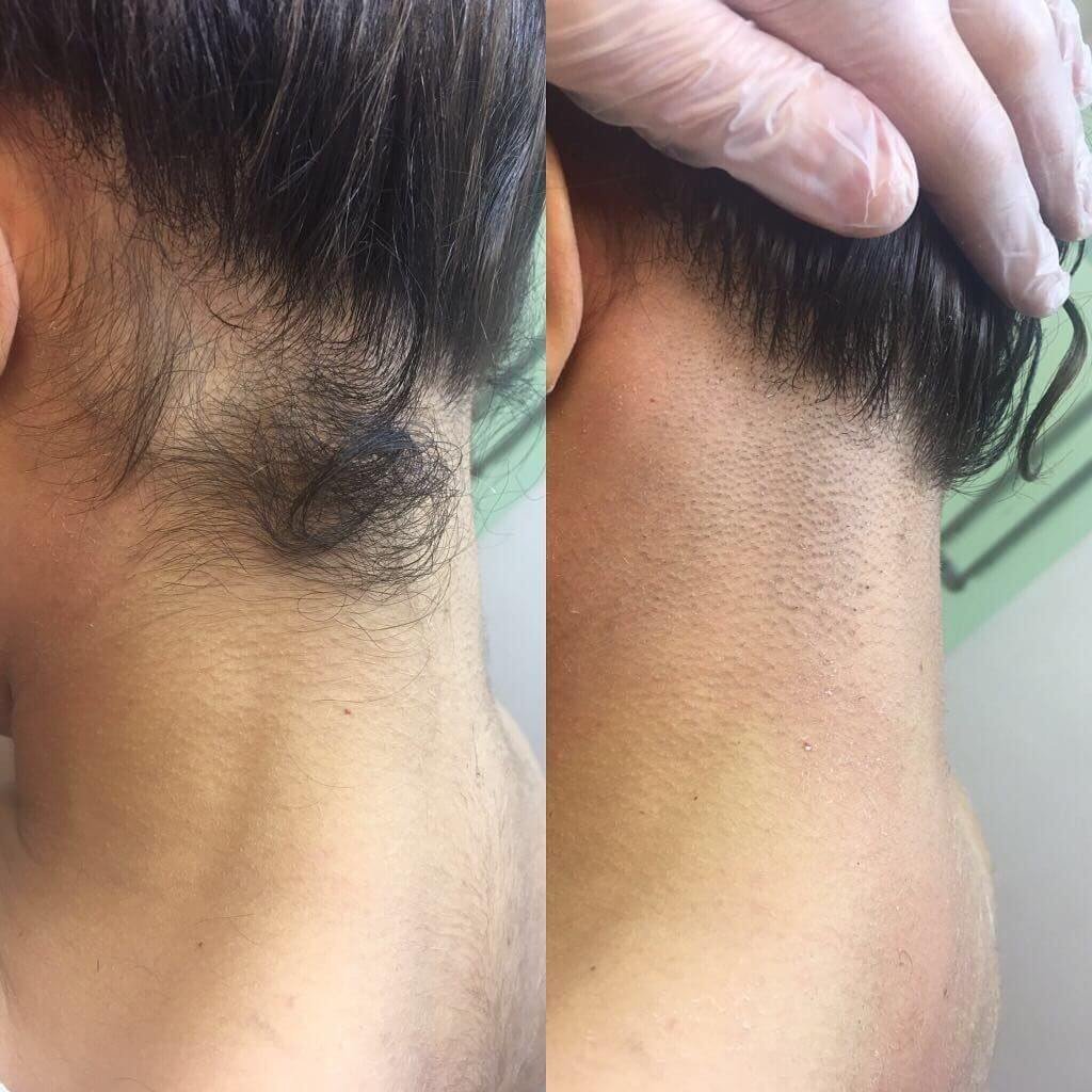 Лазерная эпиляция волос