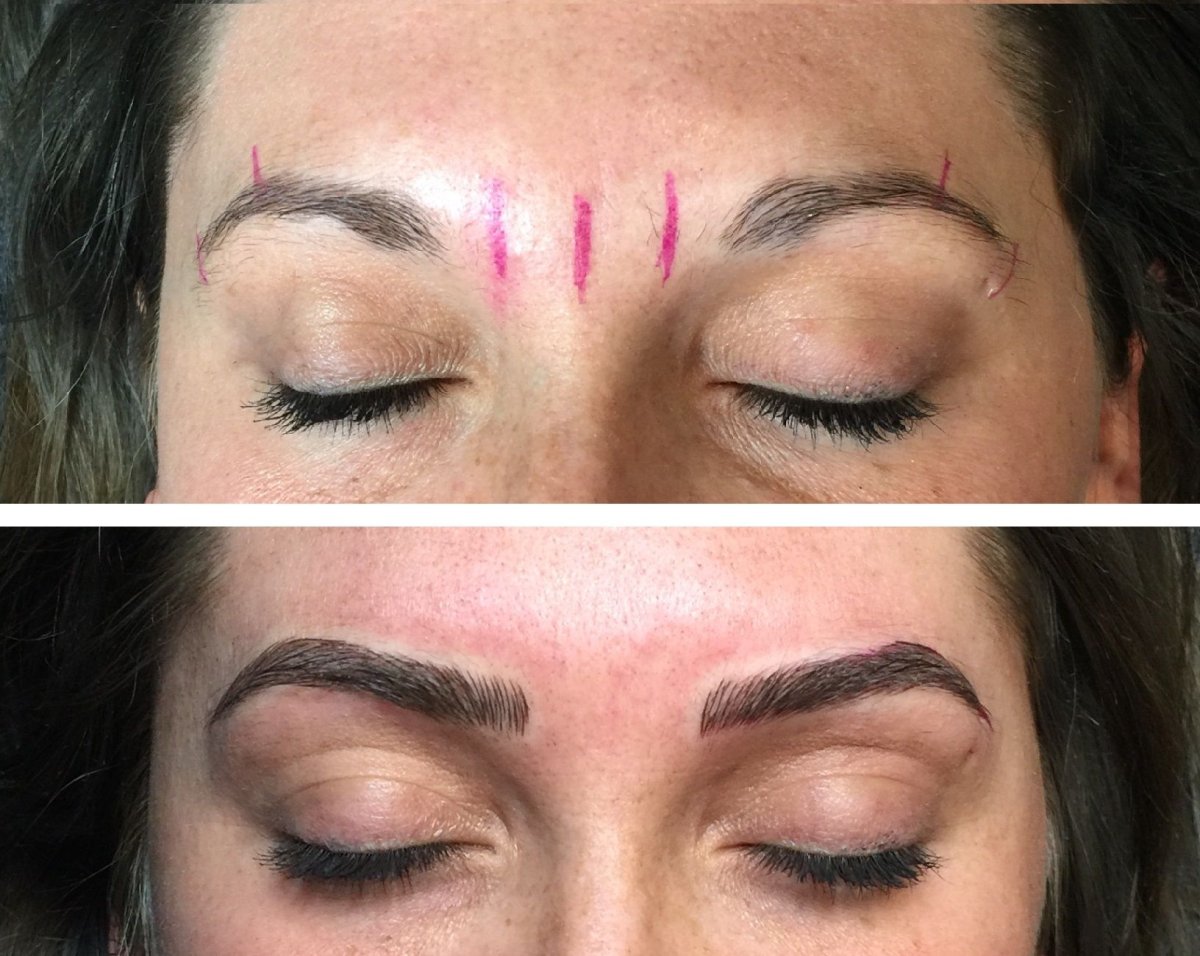 Трансплантация волос на бровях до и после