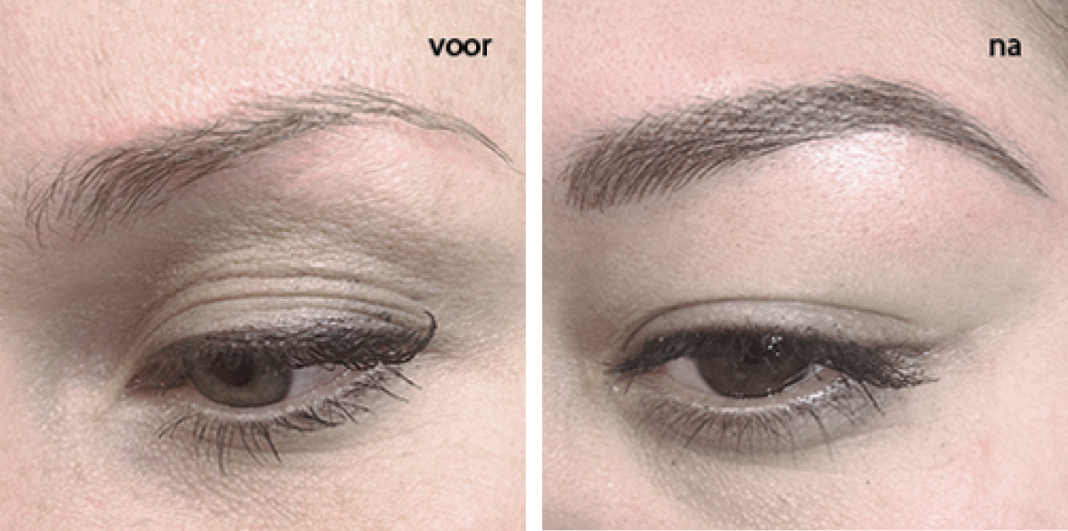 Пересаживание волос на брови