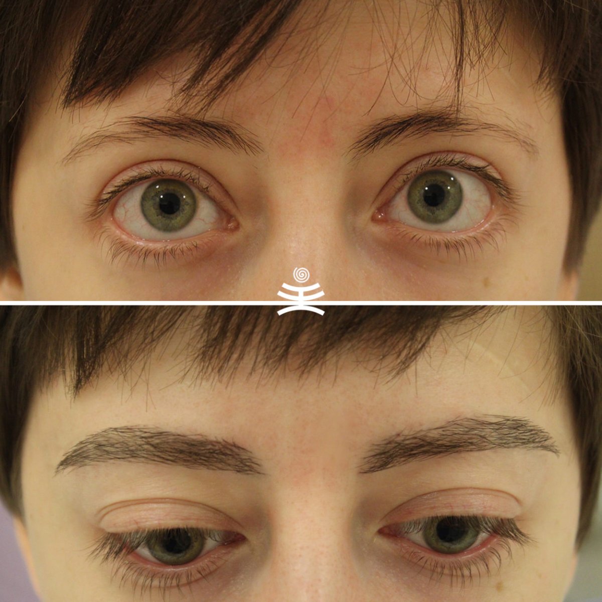 Пересаженные брови до и после