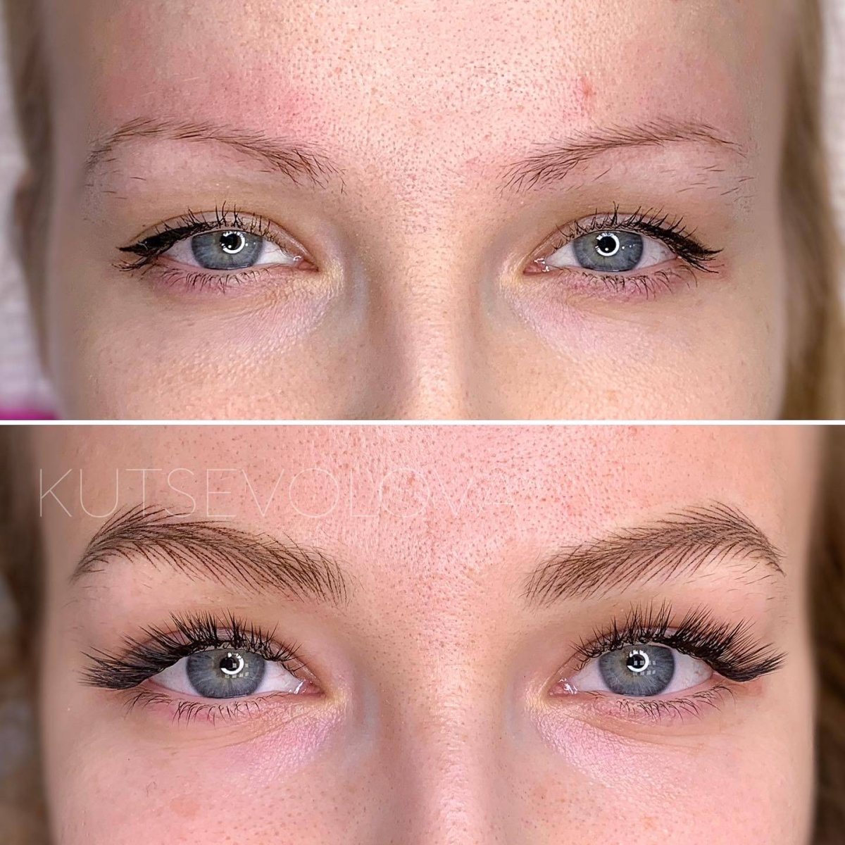 Пересадка бровей знаменитости