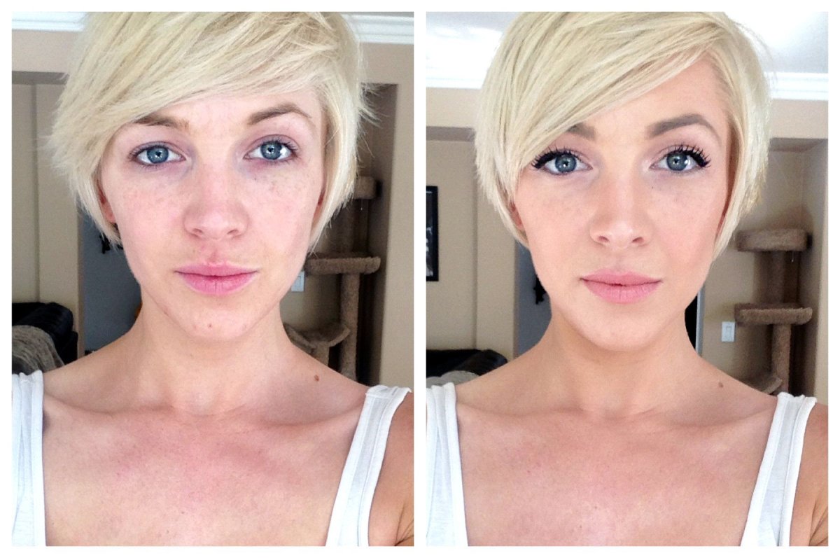 Сильная асимметрия глаз