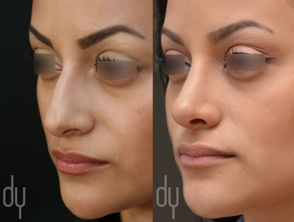 Накладные носы