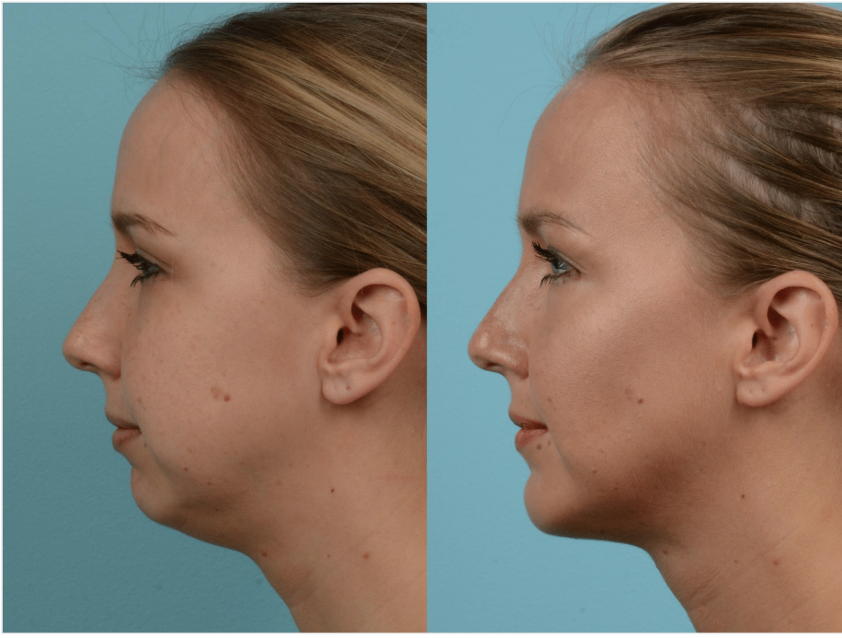 Маленький подбородок