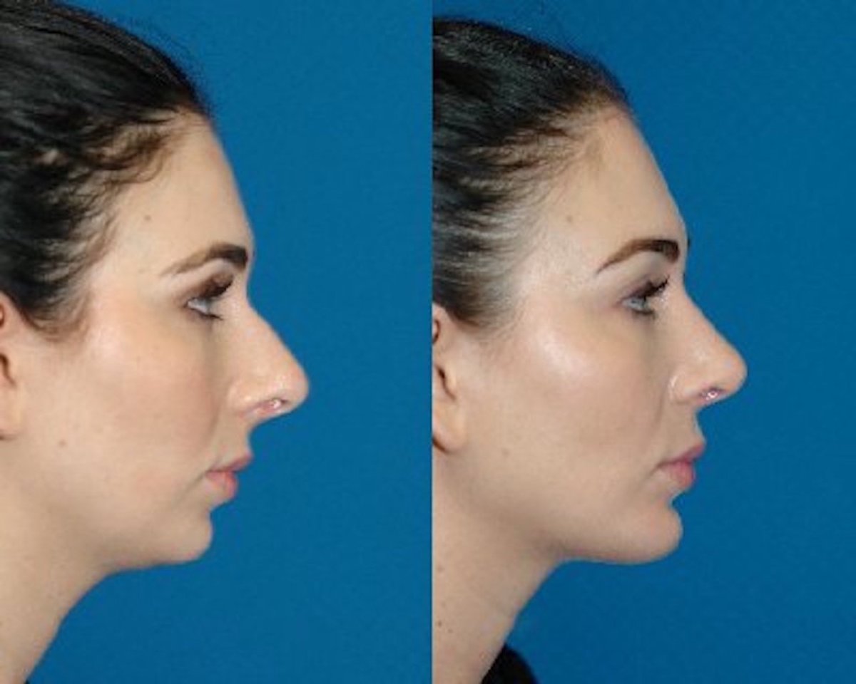 Выступающий подбородок