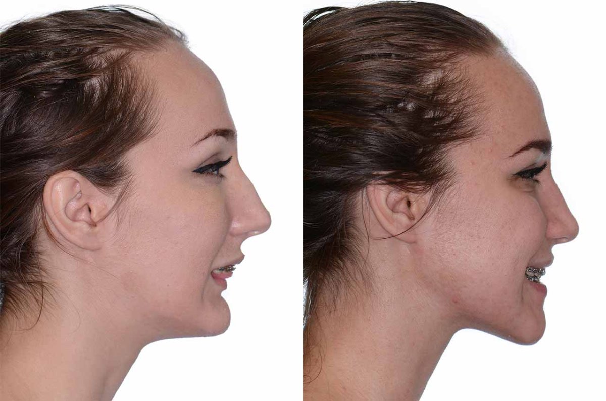 Дистальный прикус подбородок