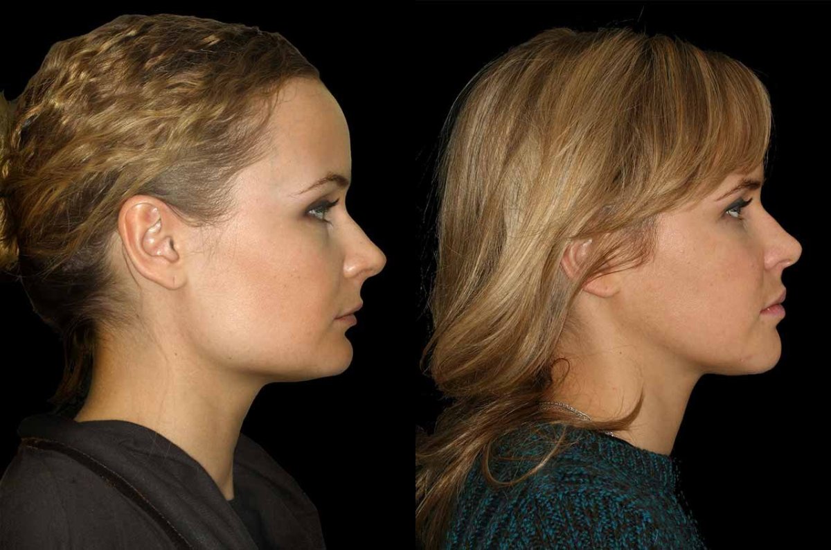 Маленький подбородок