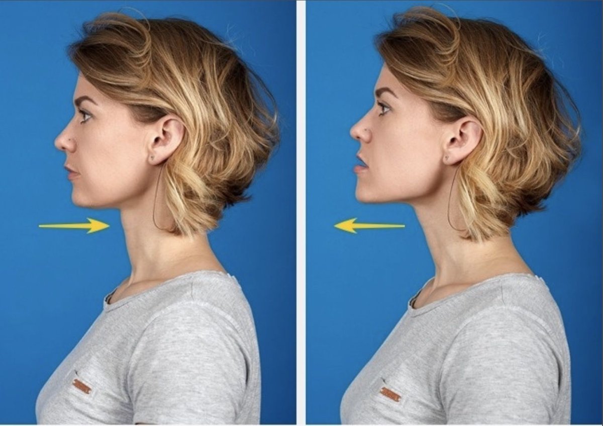 Второй подбородок у подростка