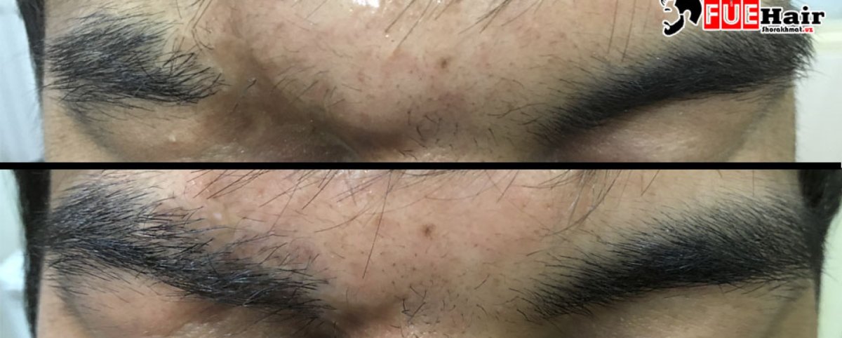 Трансплантация волос, ресниц и бровей