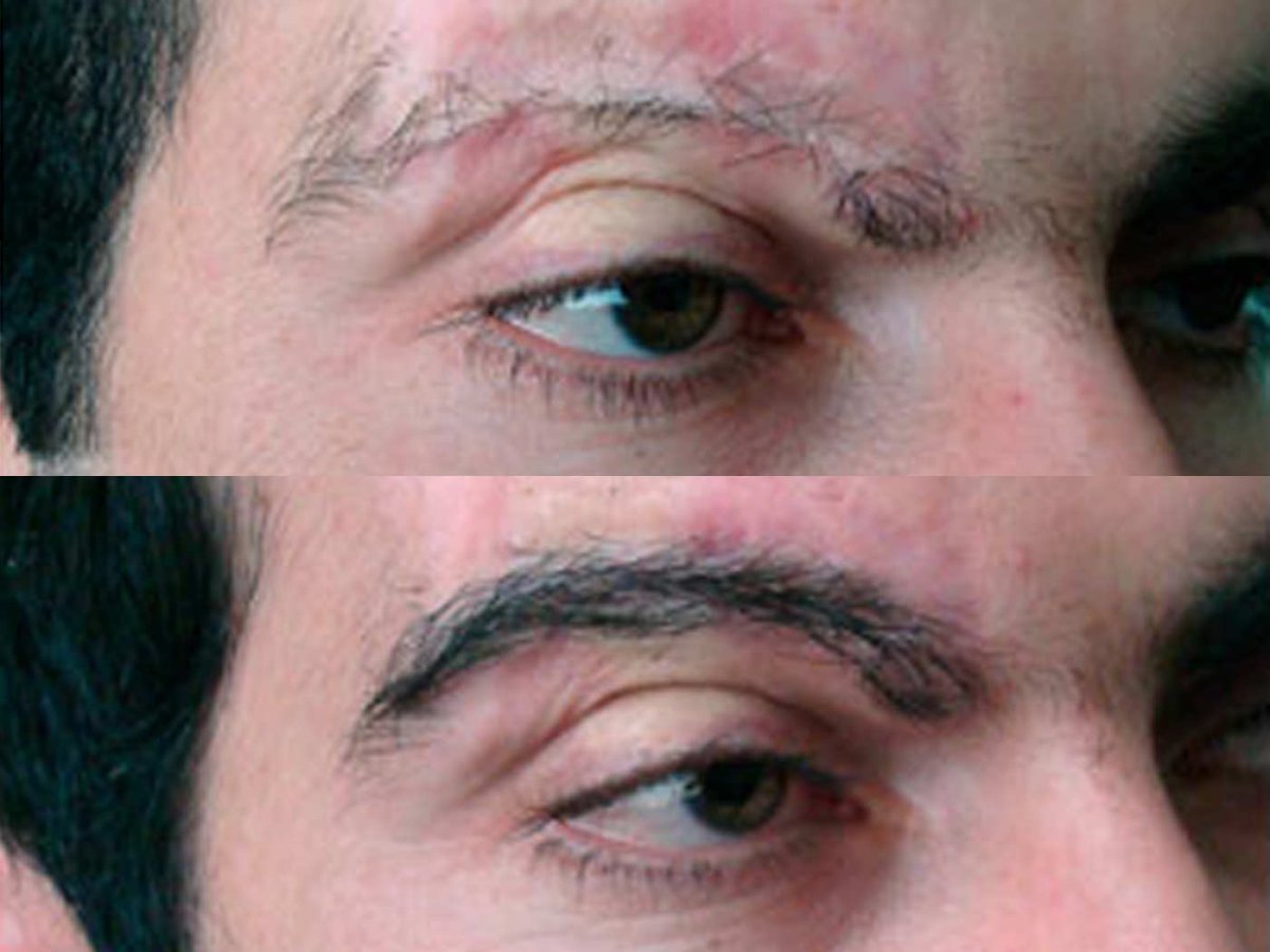 Мария Погребняк пересадка бровей