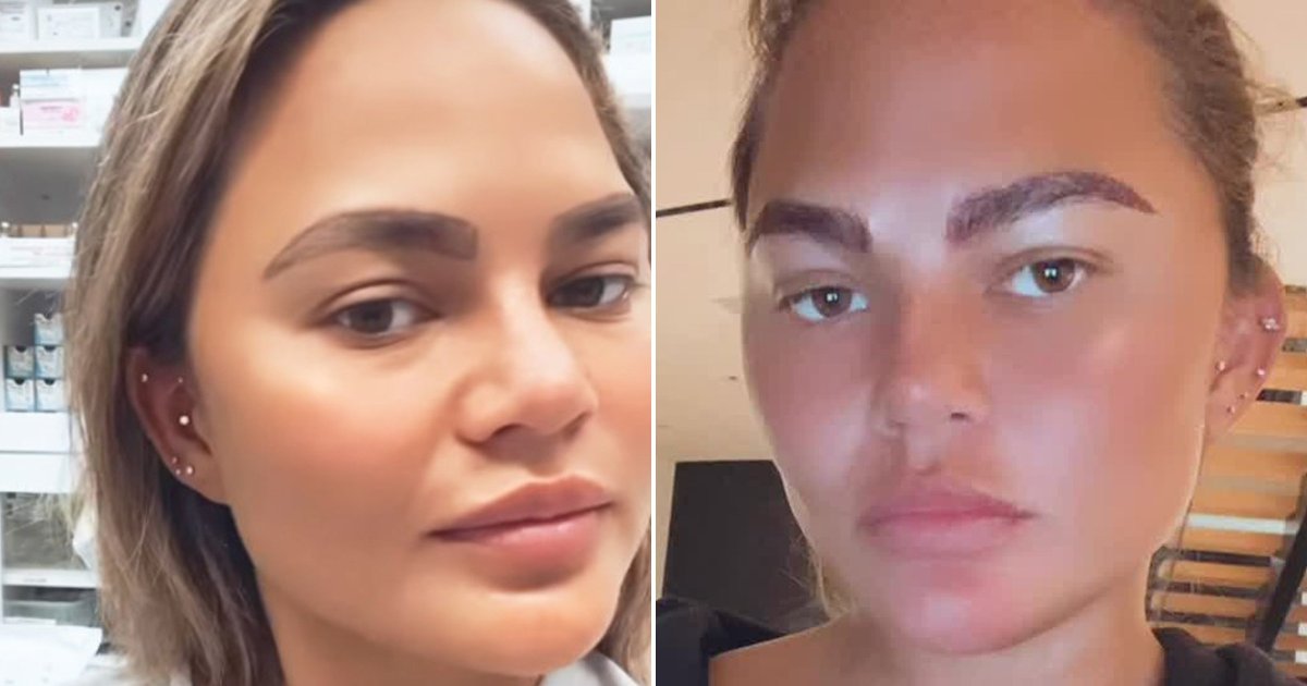 Брови после пересадки бровей