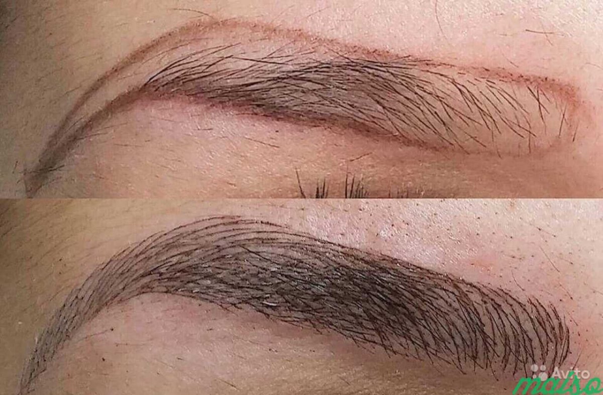 Имплантация бровей