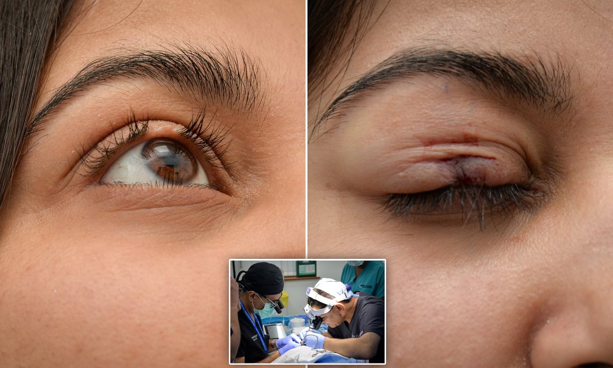 Трансплантация волос на брови