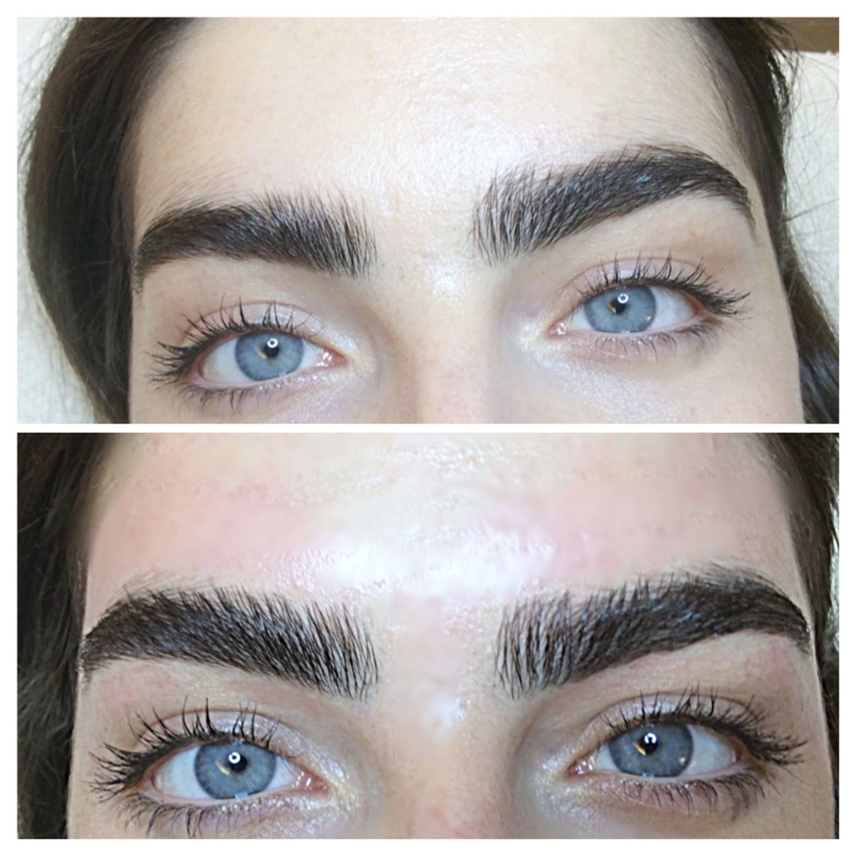 Пересаженные брови до и после