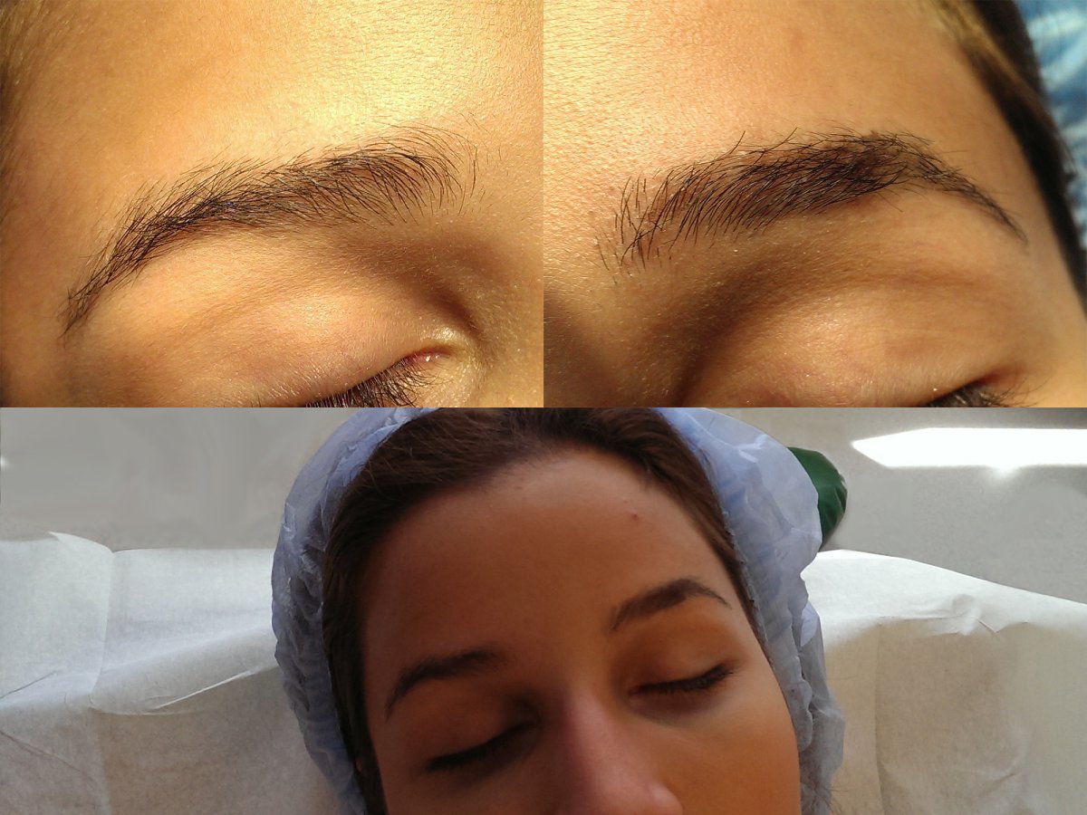 Мезотерапия бровей до и после