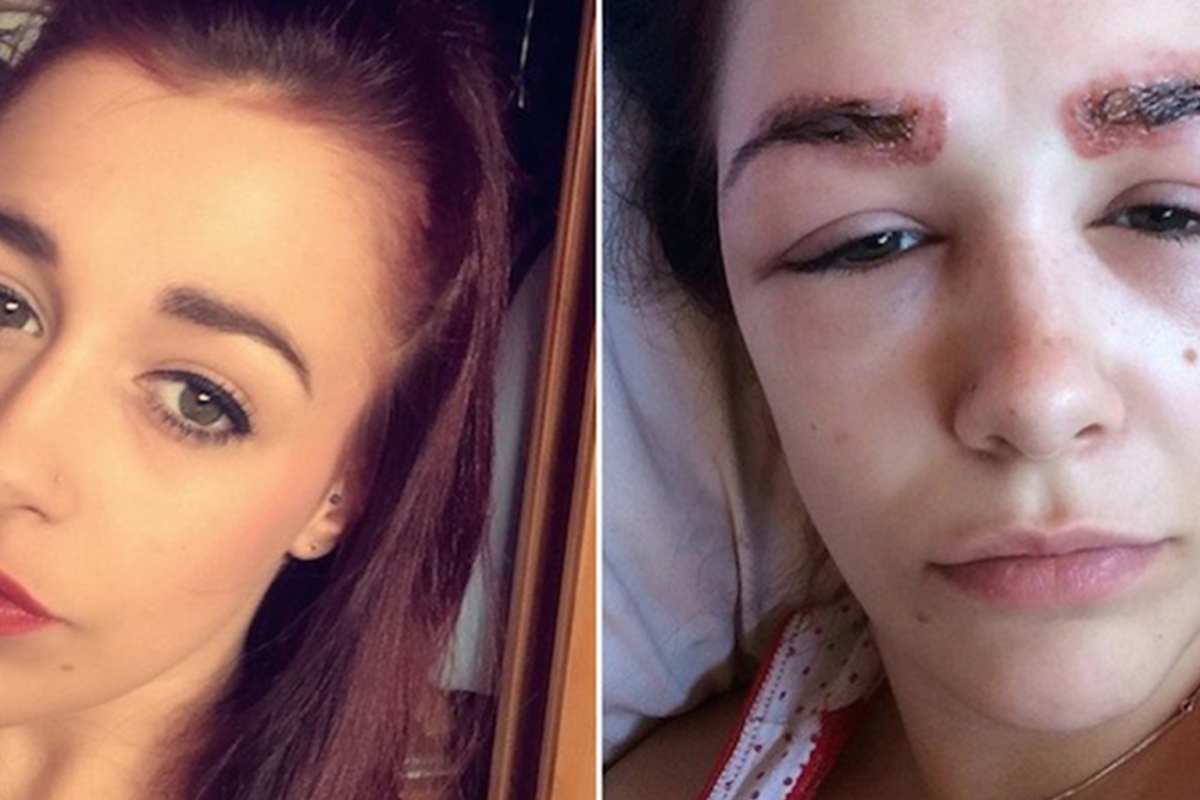 Трансплантация волос в Турции до после