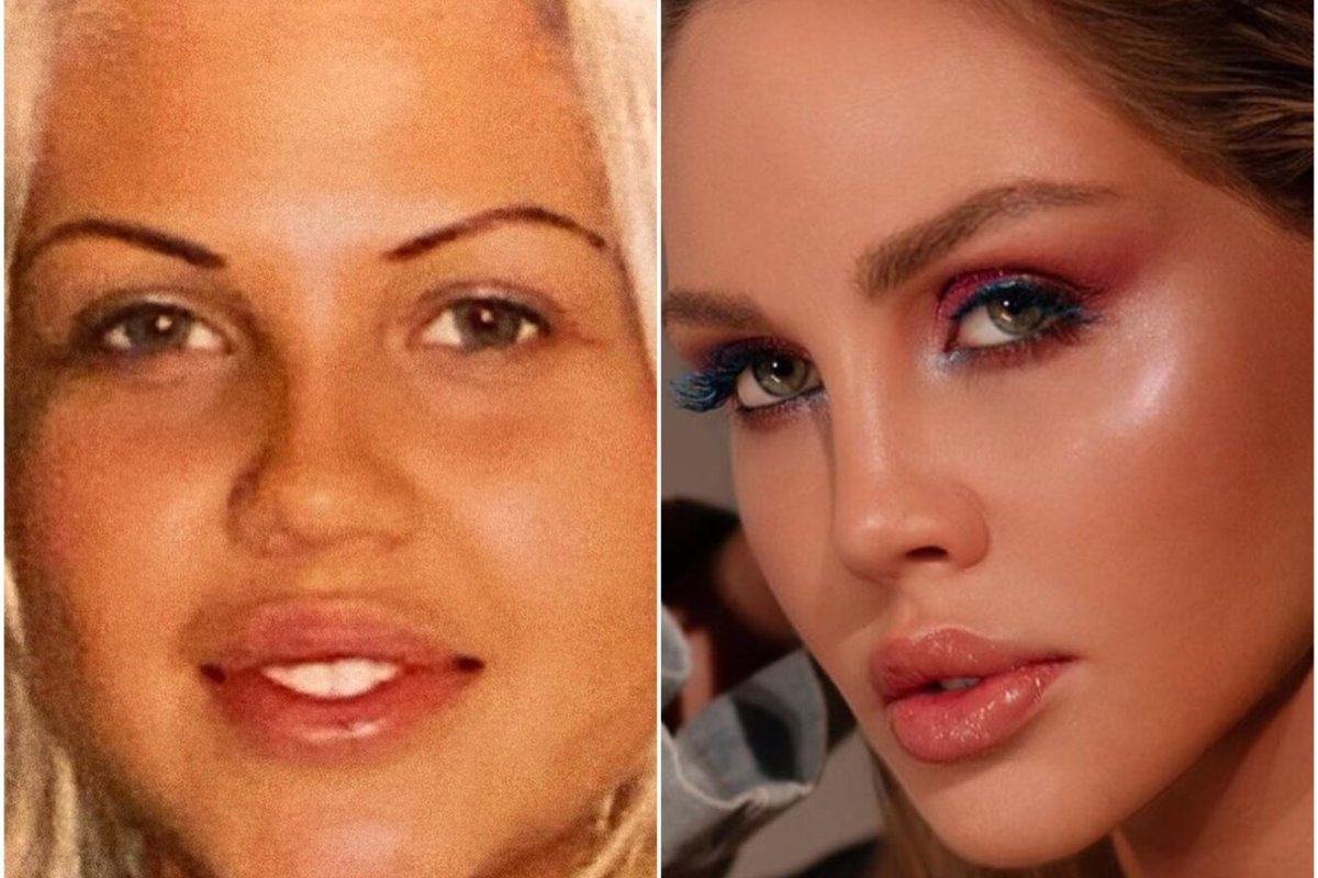 Миноксидил на брови до и после