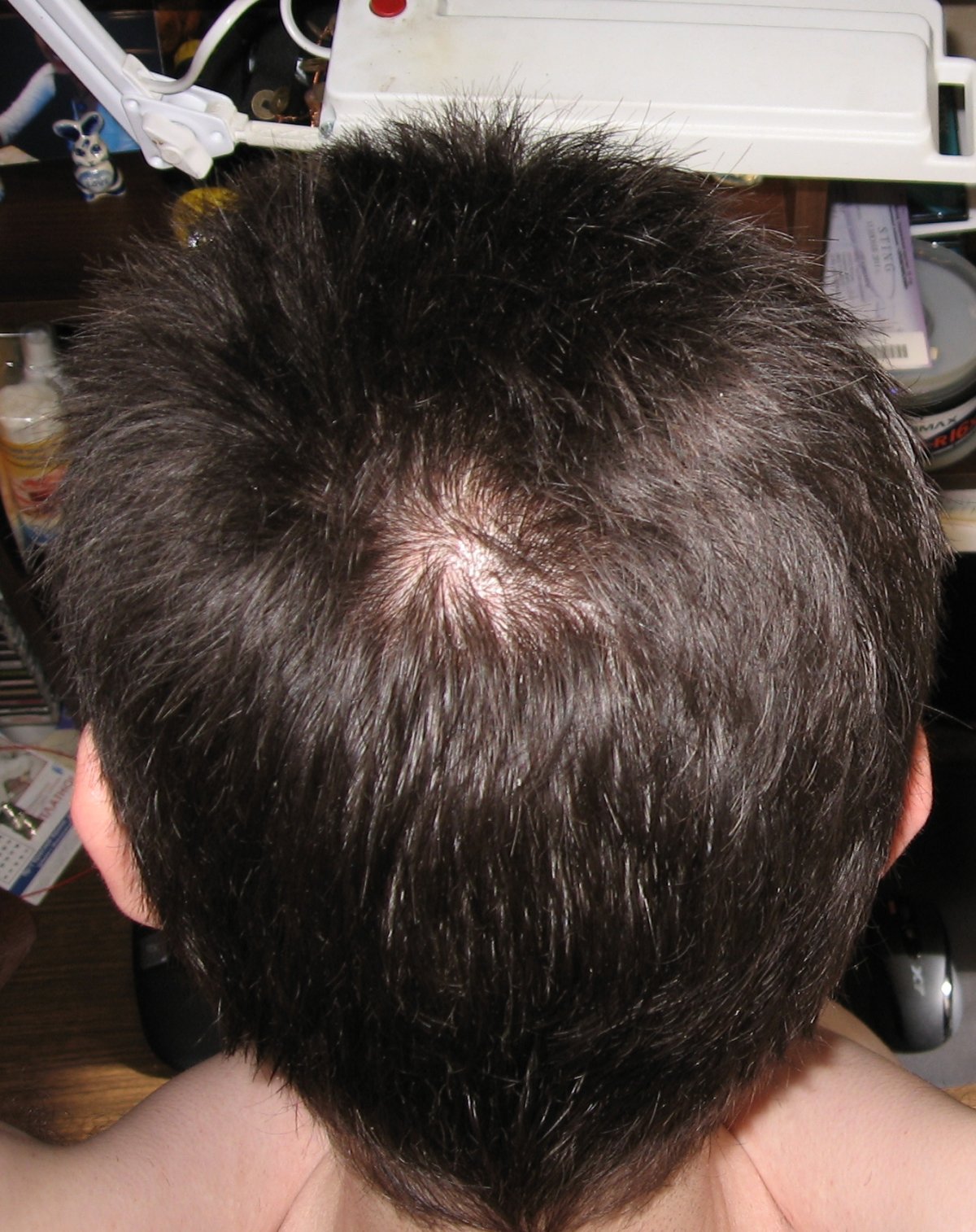 Залысина на макушке у мужчин