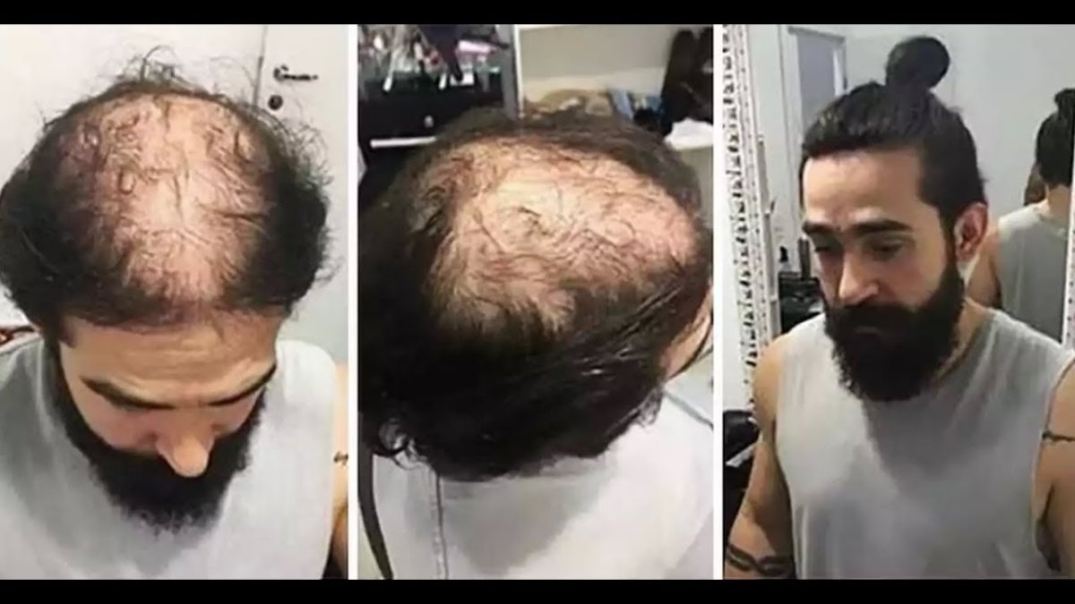 Облысение с длинными волосами