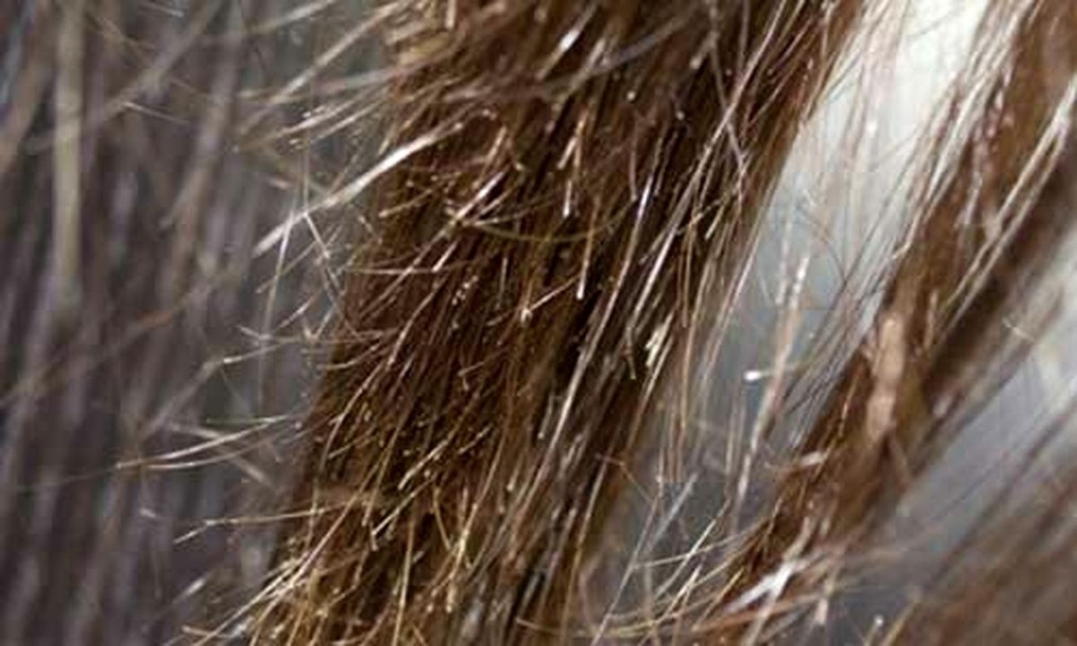 Заболевание волос Трихоптилоз